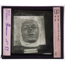Conférence antivénérienne faite à des officiers et soldats. 3ème Série. Gomme des os du nez.