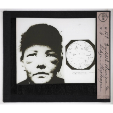 Prophylaxie des maladies contagieuses. 2e série. Transmises par les produits cutanés, le pus, les sécrétions oculaires, les parasites. Erysipèle chronique du visage. Streptocoque.