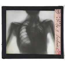 La Tuberculose. Scoliose.
