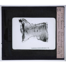 Les Principaux caractères permettant d'appriécier quelques viandes insalubres ou défectueuses. Lésions tuberculeuses de la muqueuse trachéale (boeuf).