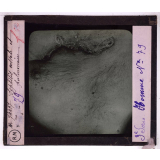 Conférence antivénérienne faite à des officiers et soldats. 3ème Série. Syphilis costale et pulmonaire.