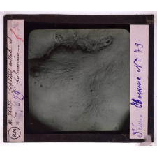 Conférence antivénérienne faite à des officiers et soldats. 3ème Série. Syphilis costale et pulmonaire.