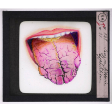 Maladies de la peau causées par des microbes. Langue fissurée syphilitique.