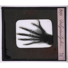 La Radiographie appliquée aux Sciences médicales. Polydactylie.