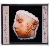 Les Maladies du cuir chevelu. Impétigo contagieux généralisé, Musée de l'hôpital St Louis.