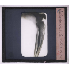La Radiographie appliquée aux Sciences médicales. Ostéopathie du tibia droit.