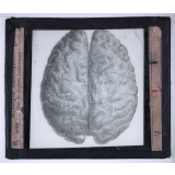 Madeleine. Méningite alcoolique. Atlas du docteur Lancereaux.