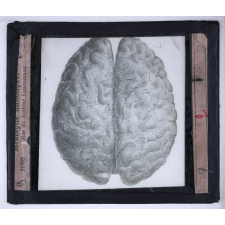 Madeleine. Méningite alcoolique. Atlas du docteur Lancereaux.