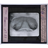 Conférence antivénérienne faite à des officiers et soldats. 2ème Série. Chancre syphilitique des seins, forme phagédénique.
