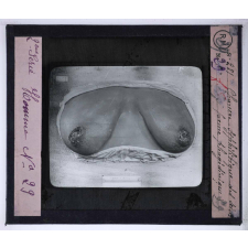 Conférence antivénérienne faite à des officiers et soldats. 2ème Série. Chancre syphilitique des seins, forme phagédénique.