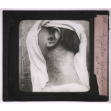 Les Maladies vénériennes. Syphilide pigmentaire du cou.