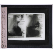 Les Dessanglés du ventre. Radiographies types de dessanglé bien ressanglé.