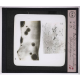 Maladies de la peau causées par des microbes. Echtyma de la jambe - Streptocoque.