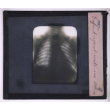 La Radiographie appliquée aux Sciences médicales. Enfant ayant avalé un sou.