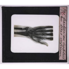 La Radiographie appliquée aux Sciences médicales. Fracture du cubitus au tiers inférieur.