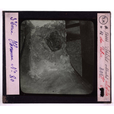 Conférence antivénérienne faite à des officiers et soldats. 3ème Série. Syphilis osseuse ulcérée du tibia.