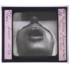 Conférence antivénérienne faite à des ouvrières. 1ère Série. Syphilides ulcéreuses de la langue et des lèvres.