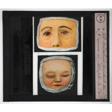 Prophylaxie des maladies contagieuses. 2e série. Transmises par les produits cutanés, le pus, les sécrétions oculaires, les parasites. Ophtalmie purulente du nouveau-né. Atrophie de l'œil.