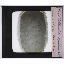Les Maladies du cuir chevelu. Follicule épilante, Musée de l'hôpital St Louis.