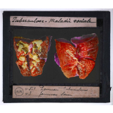 La Tuberculose, maladie sociale. Poumon tuberculeux. Poumon sain.