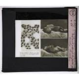 Prophylaxie des maladies contagieuses. 1ère série. Transmises par les déjections, les matières fécales, l'eau souillée; les sécrétions respiratoire. Méningocoque de Weichselbaum. Enfant atteint de méningite cérébro-spinale.