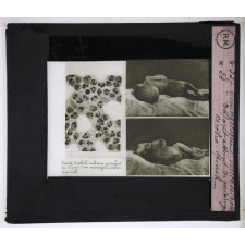 Prophylaxie des maladies contagieuses. 1ère série. Transmises par les déjections, les matières fécales, l'eau souillée; les sécrétions respiratoire. Méningocoque de Weichselbaum. Enfant atteint de méningite cérébro-spinale.