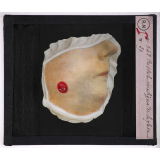 Maladies de la peau causées par des microbes. Pustule maligne de la face.