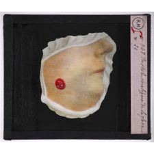 Maladies de la peau causées par des microbes. Pustule maligne de la face.