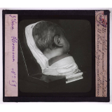 Conférence antivénérienne faite à des officiers et soldats. 3ème Série. Syphilis gommeuse, région mastoïdienne. 