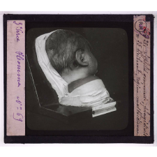 Conférence antivénérienne faite à des officiers et soldats. 3ème Série. Syphilis gommeuse, région mastoïdienne.