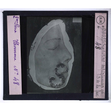 Conférence antivénérienne faite à des officiers et soldats. 2ème Série. Syphilides serpigineuses en S de la face.