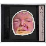 Prophylaxie des maladies contagieuses. 2e série. Transmises par les produits cutanés, le pus, les sécrétions oculaires, les parasites. Erysipèle de la face.