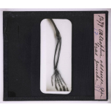 La Radiographie appliquée aux Sciences médicales. Atrophie osseuse du bras gauche.