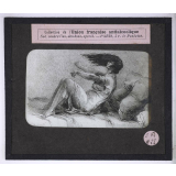 Vues anti-alcooliques. Épilepsie absinthique chez une femme. 