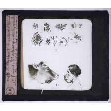 Maladies transmises à l'homme par les animaux. 1° Mycélium et massues d'Actinomyces - 2° actinomycose du maxillaire inférieur chez un boeuf et chez une femme.