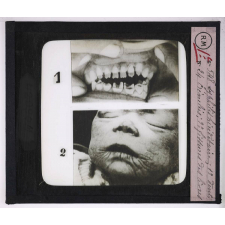 Maladies de la peau causées par des microbes. Syphilis héréditaire: 1° Dents crénelées; 2° Fissures des lèvres.
