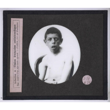 Vues anti-alcooliques. Enfant d'alcoolique. 