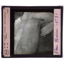 Conférence antivénérienne faite à des officiers et soldats. 3ème Série. Syphilis urétrale post-traumatique à distance.