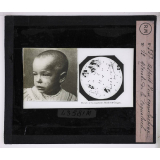 Prophylaxie des maladies contagieuses. 1ère série. Transmises par les déjections, les matières fécales, l'eau souillée; les sécrétions respiratoire. Aspect d'un coquelucheux. Microbe de la coqueluche.