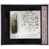 Maladies de la peau causées par des microbes. 1° Chancre mou du doigt; 2° bacille de Ducrey.