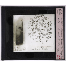 Maladies de la peau causées par des microbes. 1° Chancre mou du doigt; 2° bacille de Ducrey.