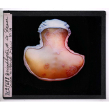 Les Maladies du cuir chevelu. Trichophytie de la peau, Musée de l'hôpital St Louis.