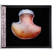 Les Maladies du cuir chevelu. Trichophytie de la peau, Musée de l'hôpital St Louis.