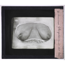 Les Maladies vénériennes. Chancres phagédéniques des seins.