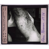 Conférence antivénérienne faite à des officiers et soldats. 3ème Série. Syphilis sous cutanée gommeuse, post traumatique de la jambe.