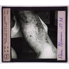 Conférence antivénérienne faite à des officiers et soldats. 3ème Série. Syphilis sous cutanée gommeuse, post traumatique de la jambe.