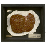 Anatomie Humaine : Pathologie humaine. 33- Foie d'alcoolique. Cirrhose.