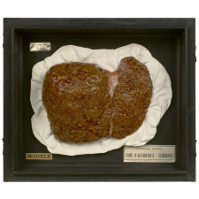 Anatomie Humaine : Pathologie humaine. 33- Foie d'alcoolique. Cirrhose.